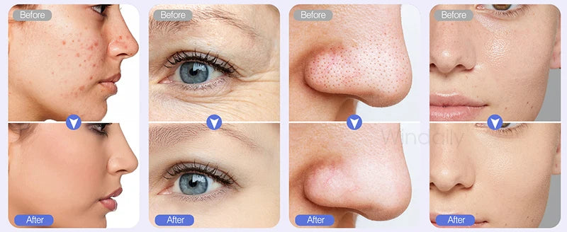 2025 Wireless Diamond Microdermabrasion Machine Blackhead Remover Vacuum Pore Cleaner Facial Skin Care Tool Face Beauty Device