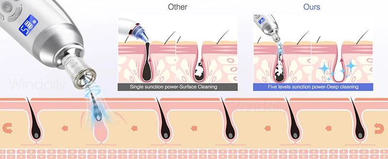 2025 Wireless Diamond Microdermabrasion Machine Blackhead Remover Vacuum Pore Cleaner Facial Skin Care Tool Face Beauty Device