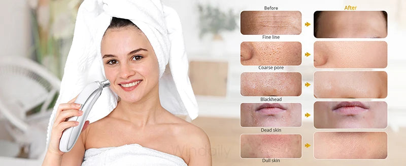 2025 Wireless Diamond Microdermabrasion Machine Blackhead Remover Vacuum Pore Cleaner Facial Skin Care Tool Face Beauty Device